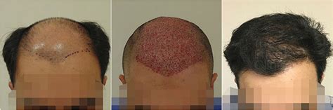 Hair Transplant 3 Months Post Surgery Results Before And After Hair