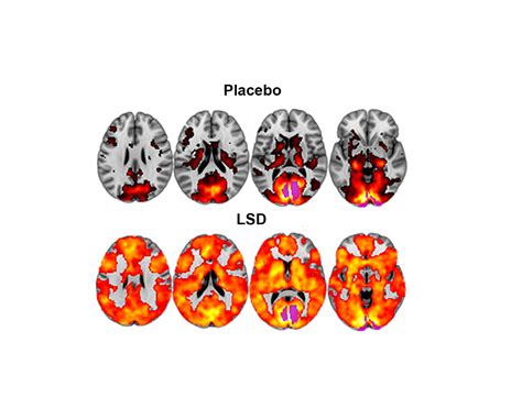 The Brain On Lsd Revealed First Scans Show How The Drug Affects The