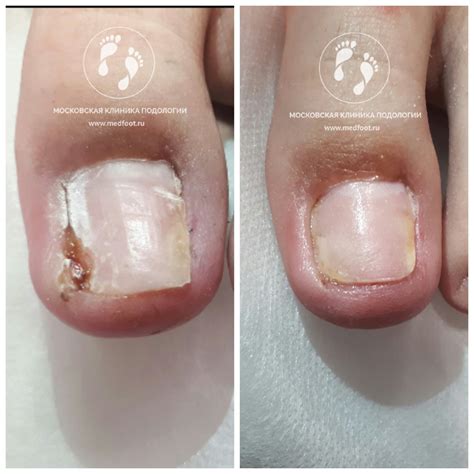 Повторное врастание ногтевой пластины | Московская Клиника Подологии