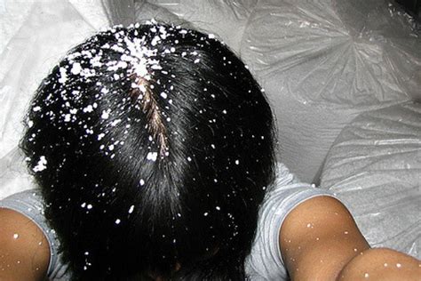 Tired Of Dandruff These Home Remedies Can Help