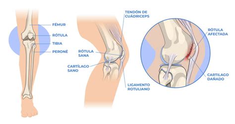 Condromalacia Rotuliana O Patelar Meds