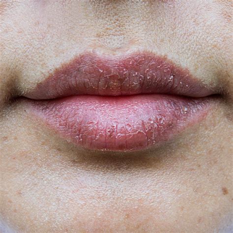 Dry Lips Treatment Causes Prevention And Cure Okeeffes Okeeffes Uk