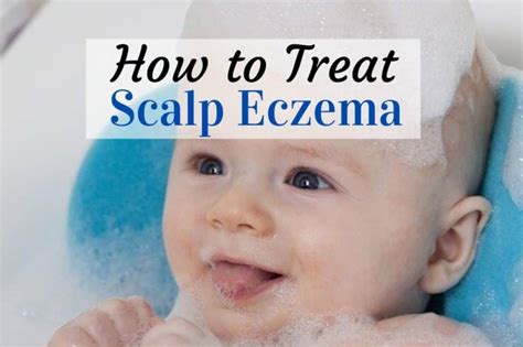 How To Treat Scalp Eczema In Babies My Itchy Child