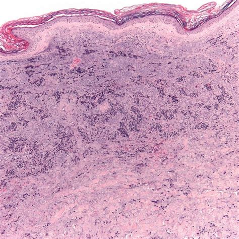Pdf Merkel Cell Carcinoma Derived Erysipelas Carcinomatosum