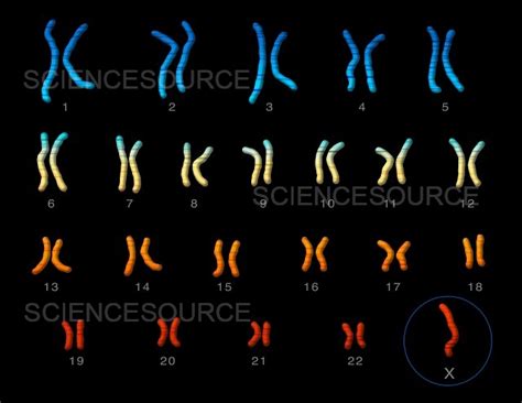 Photograph Turner S Syndrome Karyotype Science Source Images