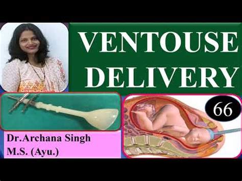 Ventouse Delivery Assisted Labour Assisted Vaginal Delivery