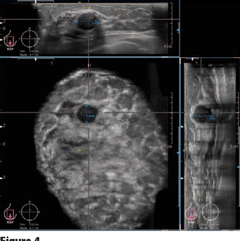 Figure 4 From Automated Whole Breast Ultrasound Semantic Scholar