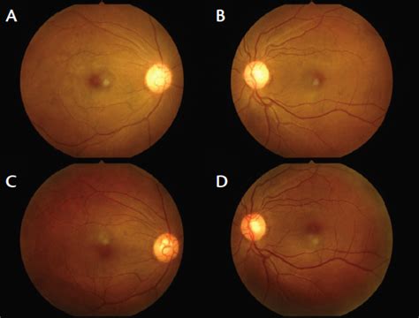 Anemia Eyes