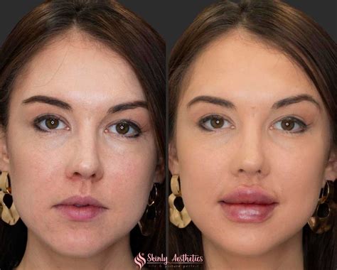 Russian Lip Filler Before And After Results Skinly Aesthetics