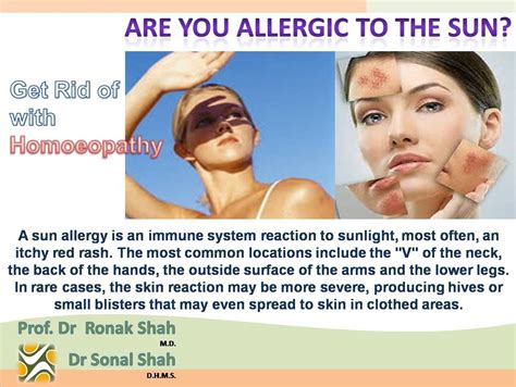 What Causes Allergy To The Sun Know Your Allergy