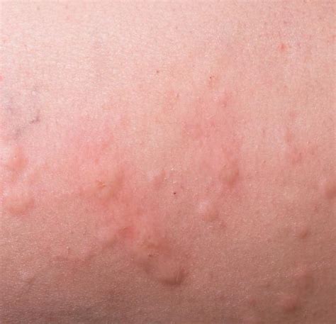 Pictures Of Skin Rashes Slideshow