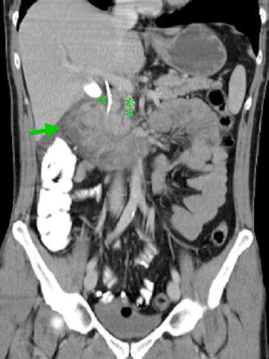 Adenomyoma Of The Pancreas Abdominal Computed Tomography Scan Reveals