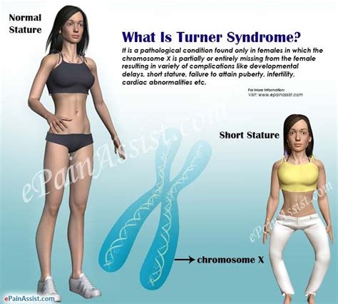 What Is Turner Syndrome Turner Syndrome Genetic Disorders Syndrome