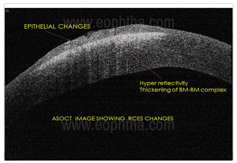 Recurrent Corneal Erosion Syndrome A Review