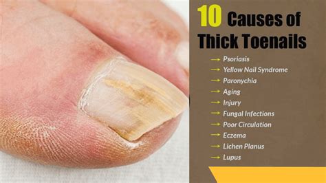 How To Get Rid Of Thick Toenails
