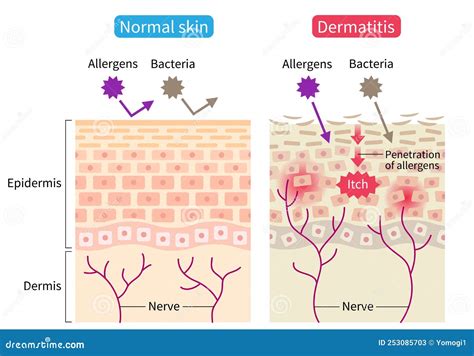 Atopic Dermatitis Eczema And Normal Skin Cell Illustration Healthy