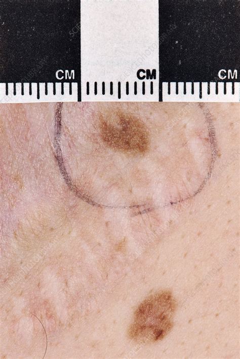 Atypical Mole Atypical Moles Diagnosis And Management