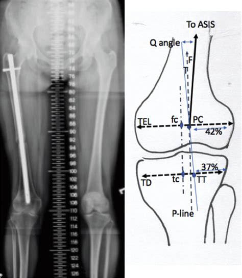 Anatomic Landmarks Are Shown Asis Anterior Superior Iliac Spine F