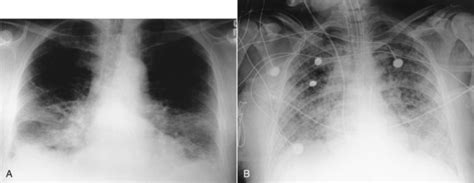 Acute Lung Injury Pulmonary Edema And Multiple System Organ Failure
