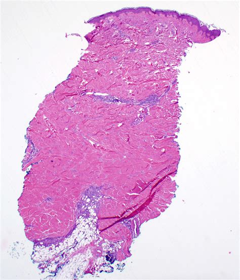 Morphea Histopathology