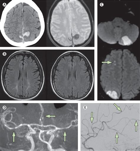 Reversible Cerebral Vasoconstriction Syndrome The Lancet Neurology
