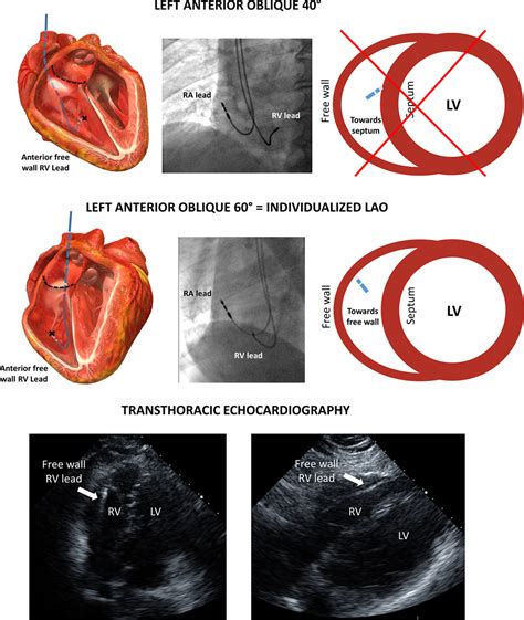 Individualized Left Anterior Oblique Projection Circulation