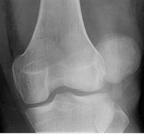 The Grades Of Patellar Luxation In Dogs Dog Discoveries
