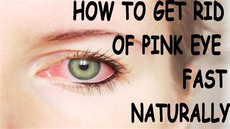 How To Get Rid Of Pink Eye Fast Conjuctivitis Treatment Naturally