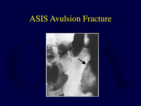 All lesser trochanteric avulsions can be treated nonoperatively. PPT - Fractures of the Pelvis and Acetabulum in Pediatric ...