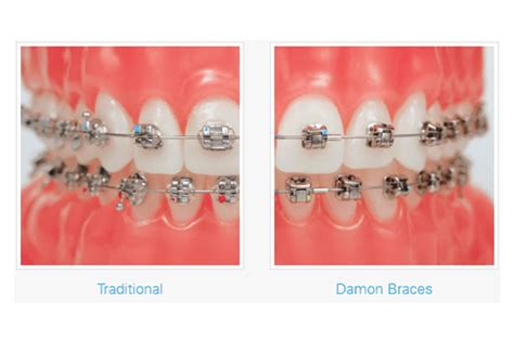 Damon Braces Orthodontic Services Burkhardt Pecora Orthodontics