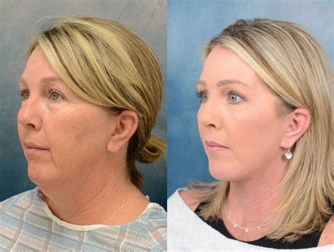 Facelift Recovery Guide Abstra Kraft
