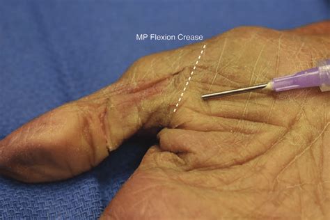Location Of Insertion Of 16 Gauge Needle Just Proximal To The Mp