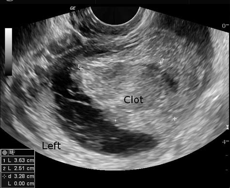 Ruptured Corpus Luteal Cyst Image