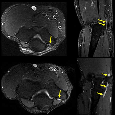 Lateral Femoral Cutaneous Nerve Mri