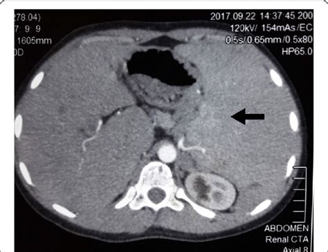 Pre Procedure Ct Mesenteric Angiogram Of Abdomen Showing Massive