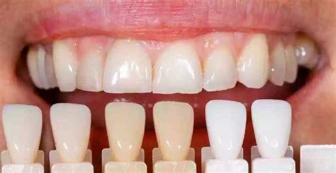Tipos De Carillas Dentales Clínica Dental Bapident