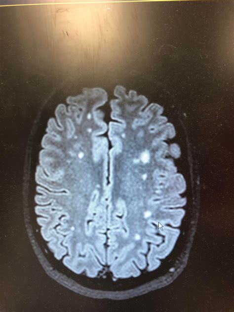My Brain Mri Showing White Matter Lesions Caused By Lupus Vasculitis