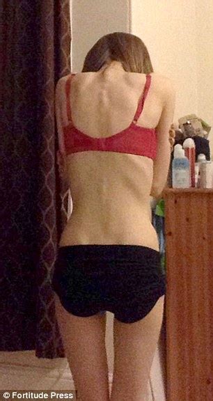 Anorexic Teenager Hollie Faye Cullen Lived Off Six Cups Of Tea A DAY