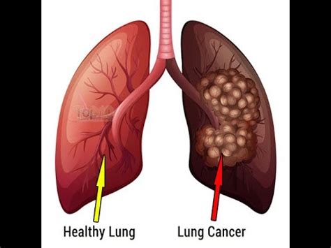 Lung cancer is a common cancer of the respiratory system that occurs when there is an uncontrolled growth of abnormal cells lining the air the main cause of lung cancer is smoking. What is Lung Cancer? Causes and Symptoms of Lung Cancer ...