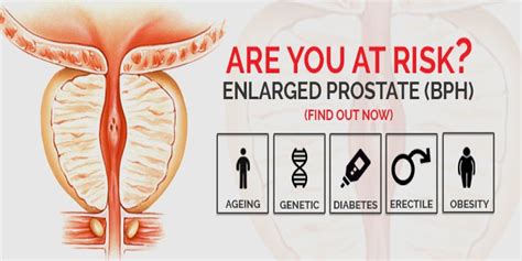 What Are The Risk Factors For Enlarged Prostate Rg Hospital