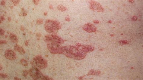How To Identify Rashes And Other Lupus Skin Symptoms 2023