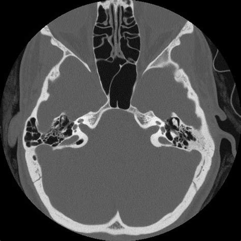 Enlarged Vestibular Aqueduct Syndrome Radiology Case Radiopaedia