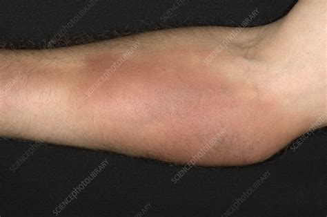 Superficial Phlebitis In The Lower Arm Stock Image M2400776