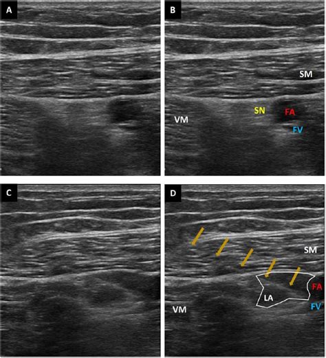 Ultrasound Guided Demonstration Of The Adductor Canal Block A And B