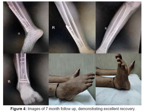 Clinical Research Foot Ankle Month