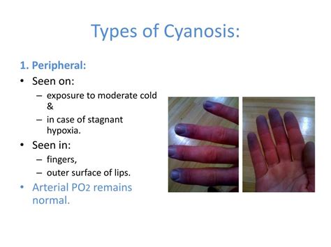 Ppt Hypoxia Types And Effects Cyanosis Hypercapnia Dyspnea