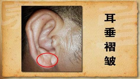 耳朵上出现这迹象 可能有冠心病 每日头条