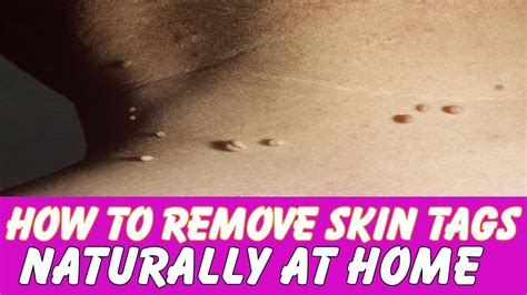 how to remove skin tags naturally 3 ways on how to remove skin tags naturally at home youtube