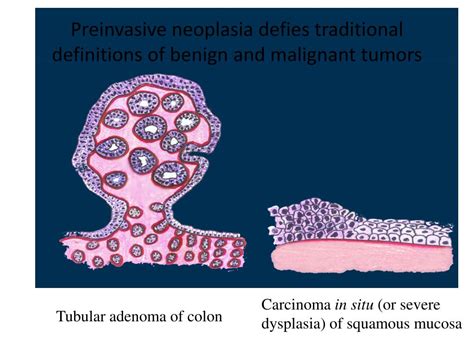 Ppt Pathology Of Neoplasia Powerpoint Presentation Free Download