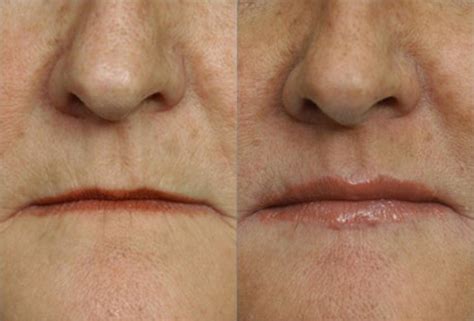 Surgical Lip Enhancement Before And After Pictures Case 118